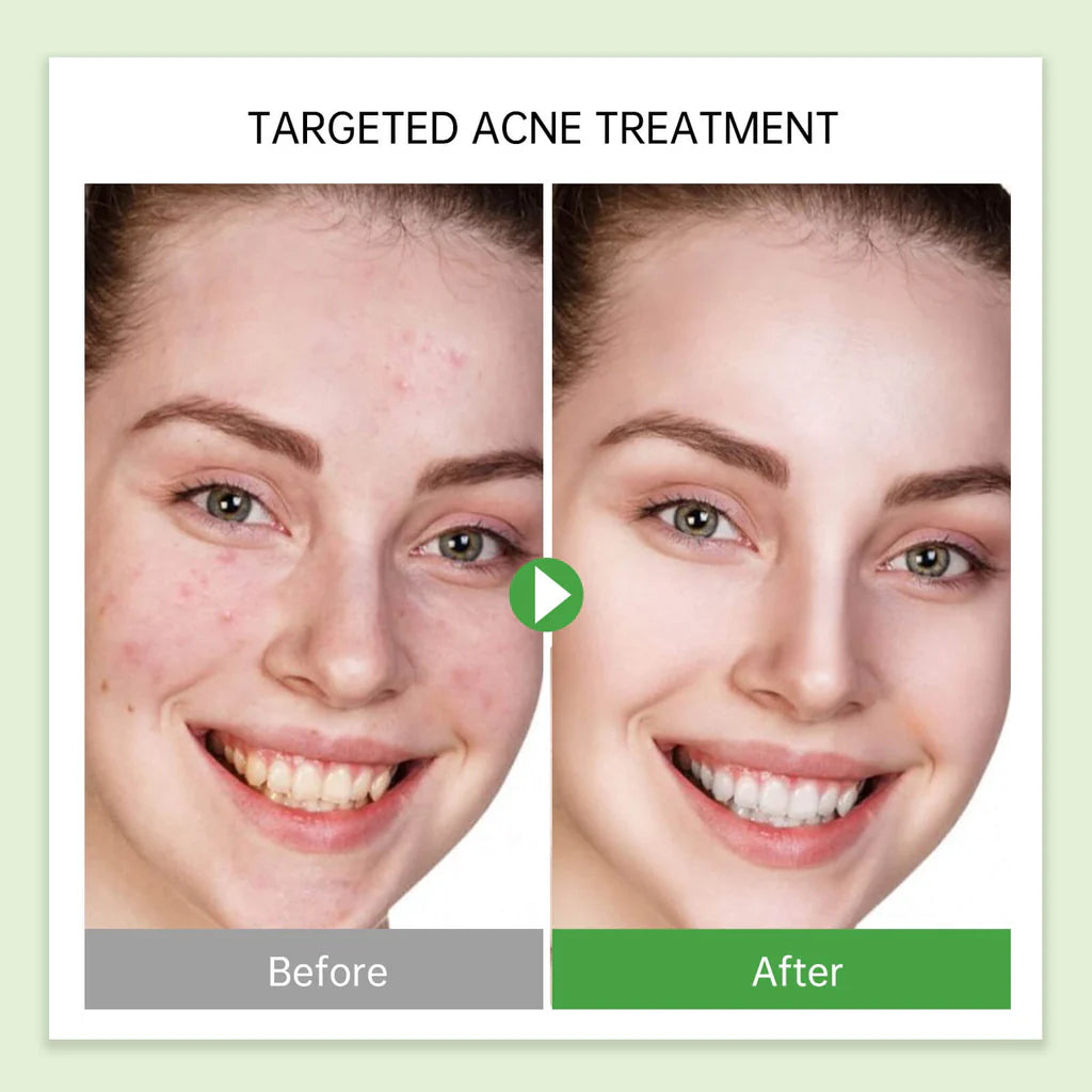 Jelly Prim Australia Tea Tree Acne Treatment Serum