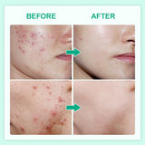 Jelly Prim Double Effect Acne Removing Serum